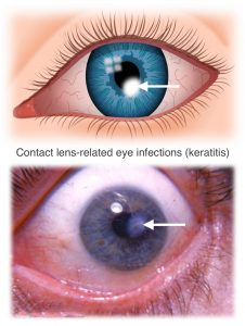 Non-Prescription Contact Lenses